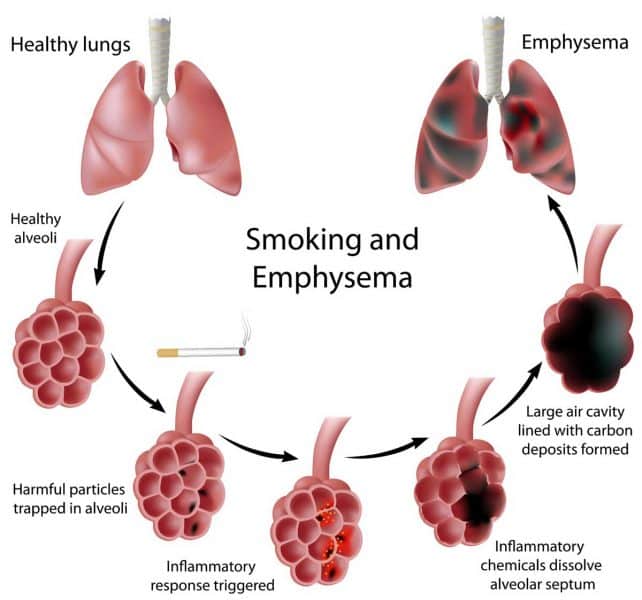 Tabaco principal causante de Enfisema