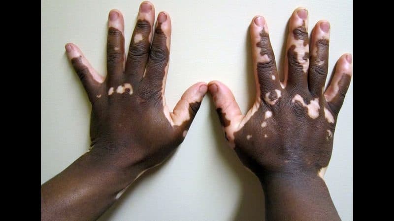25 de junio: Día Mundial del Vitiligo