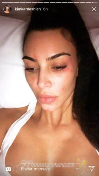 Kim Kardashian muestra rostro cubierto de psoriasis