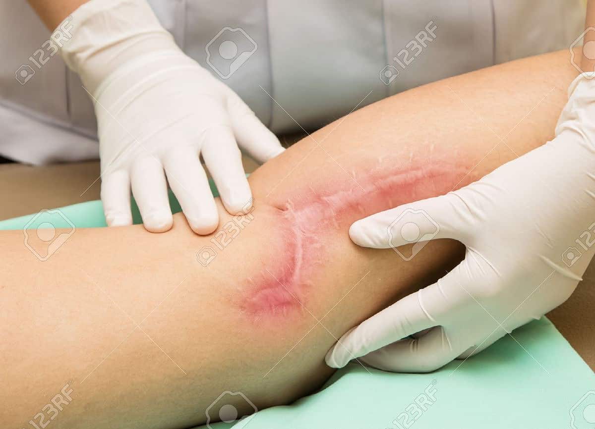 cicatriz en pierna