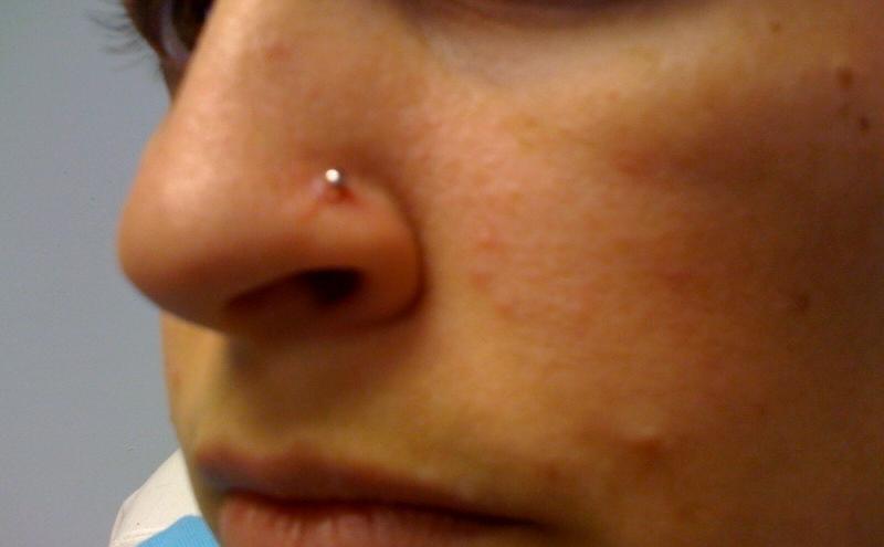 nariz con piercing infectado