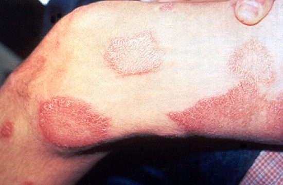 Preocupa incremento de casos de lepra en Florida